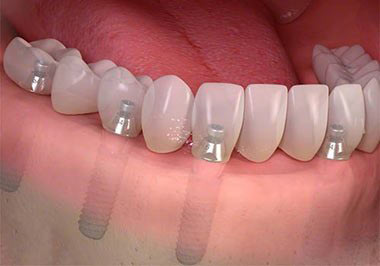 Full-Mouth-Dental-Implants-Specialist-Bronx-NY.jpg