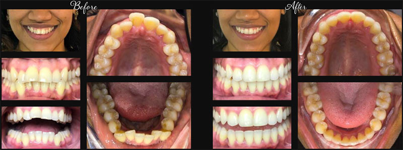 Invisalign® Antes y Después