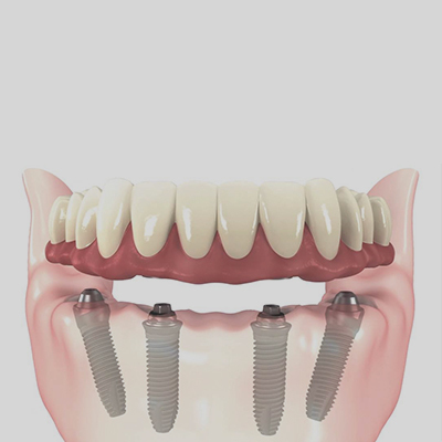 All-on-4 Dental Implants
