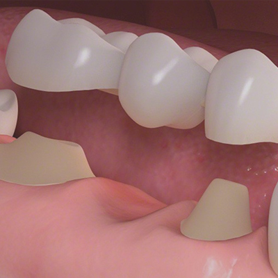 Dental Bridge Procedure