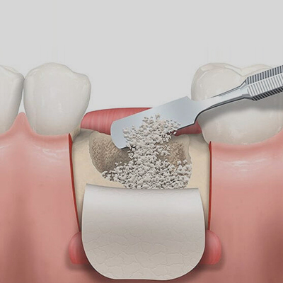 Cirugía de injerto óseo dental