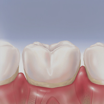 Gingivitis