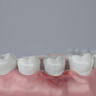 Enfermedad periodontal
