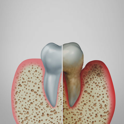 Periodontitis