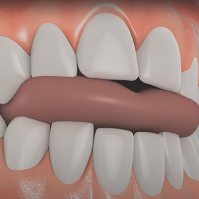 Perfect Bite Teeth Alignment
