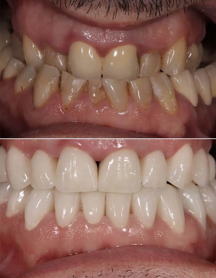Before and after comparison of cosmetic dentistry treatment showing improved tooth color, alignment, and smile aesthetics in a Bronx dental office