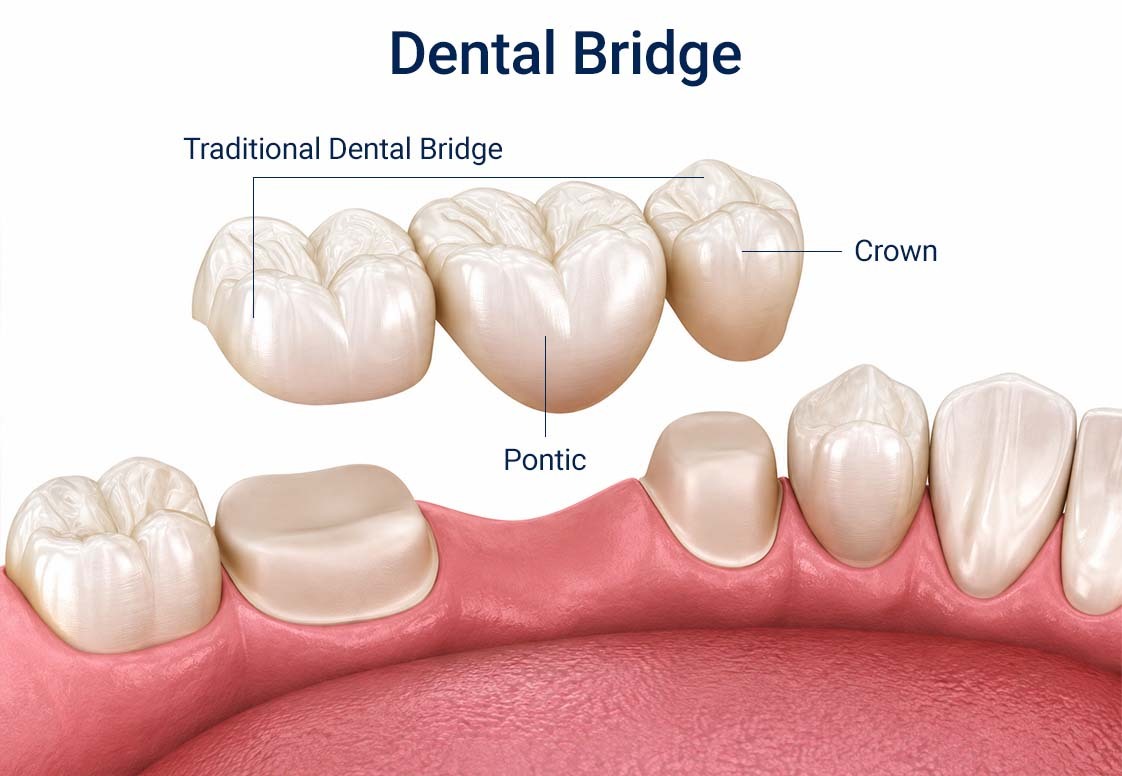 Traditional dental bridge showing an abutment crown and pontic replacing a missing tooth